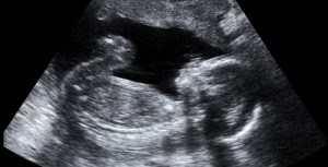 Fetal Hiccups Is It Normal